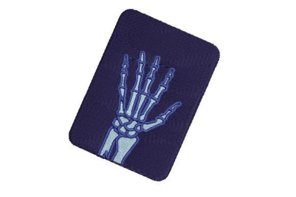 X-ray of Broken Hand