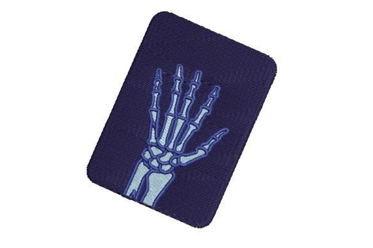 X-ray of Broken Hand