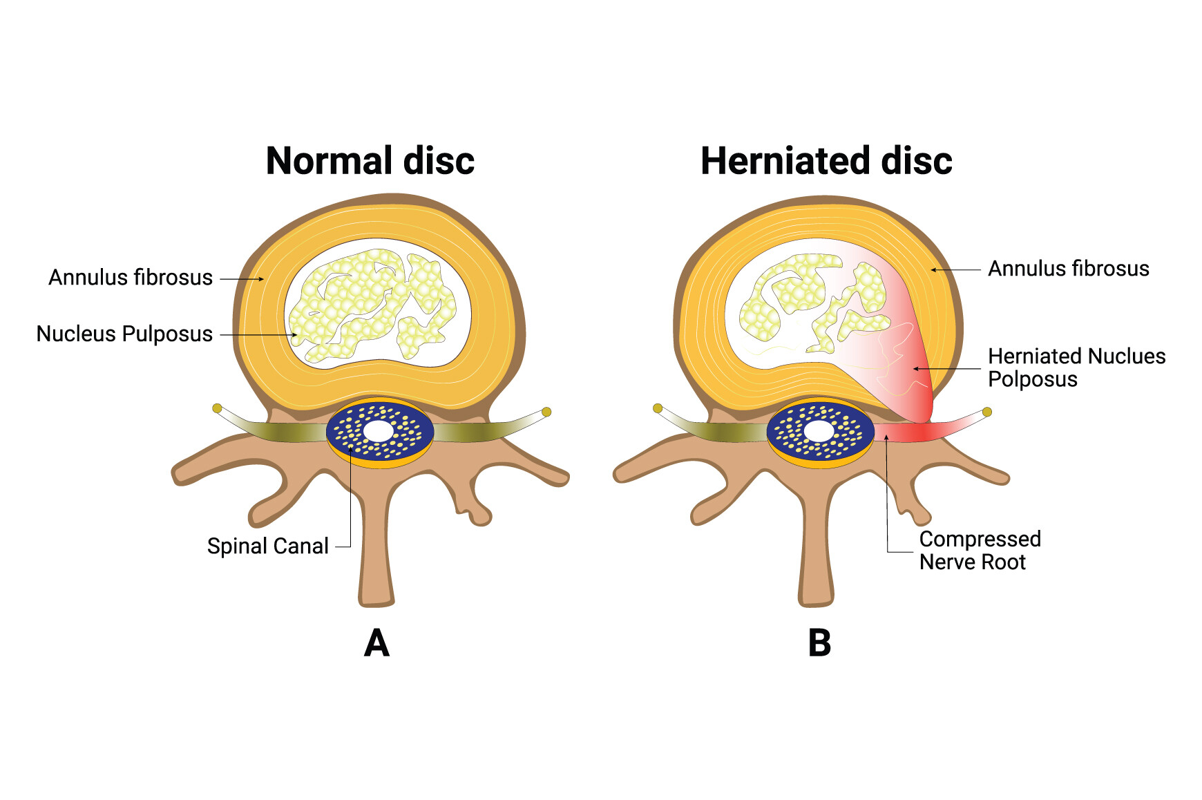 Center Disc Design Normal Disc and Herniated Disc Design Graphic by hamjaiu · Creative Fabrica