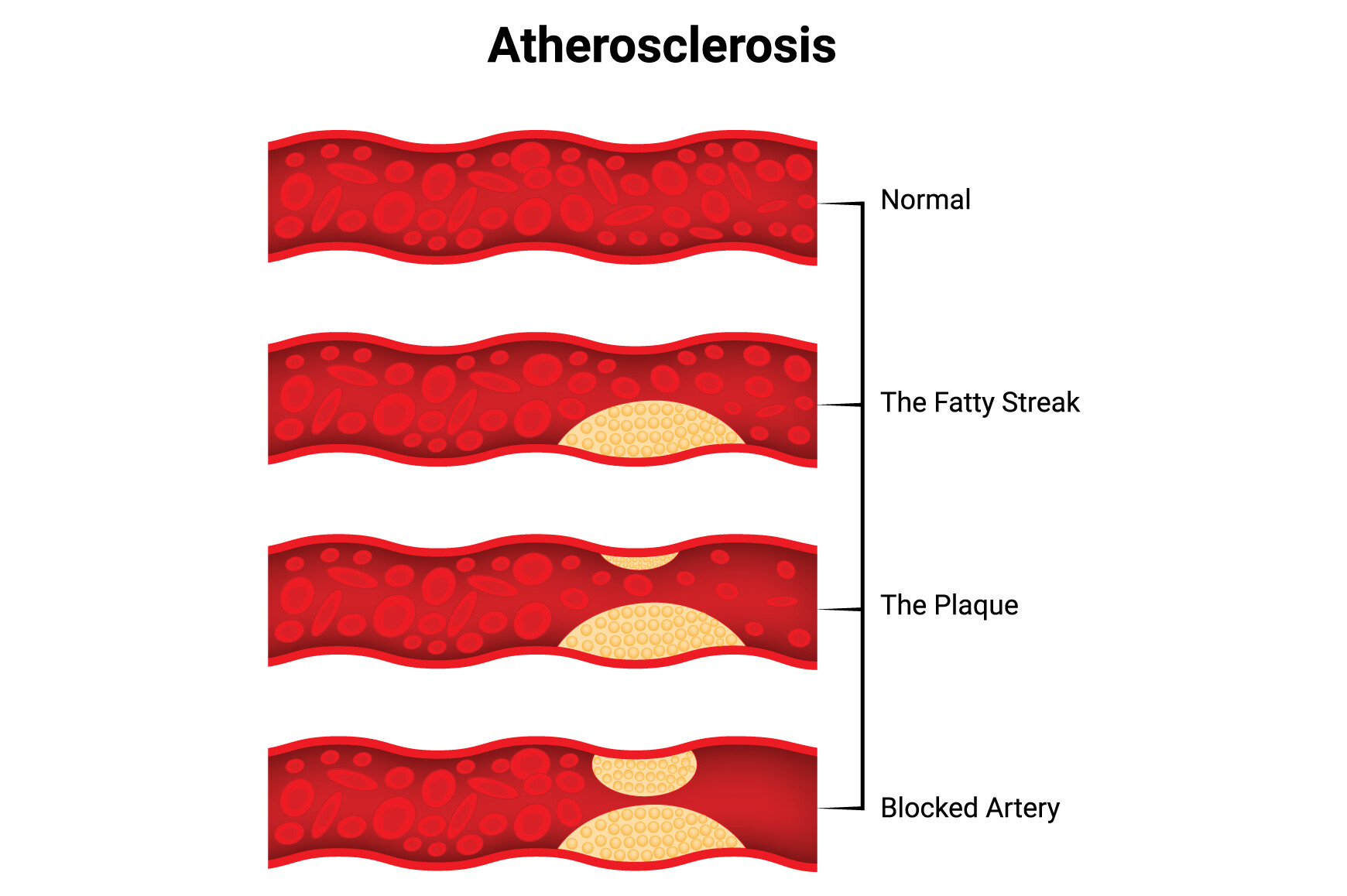 Atherosclerosis Science Design Vector Graphic by hamjaiu · Creative Fabrica