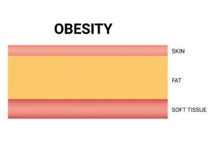 Obesity Science Design Vector Diagram Graphic by hamjaiu · Creative Fabrica