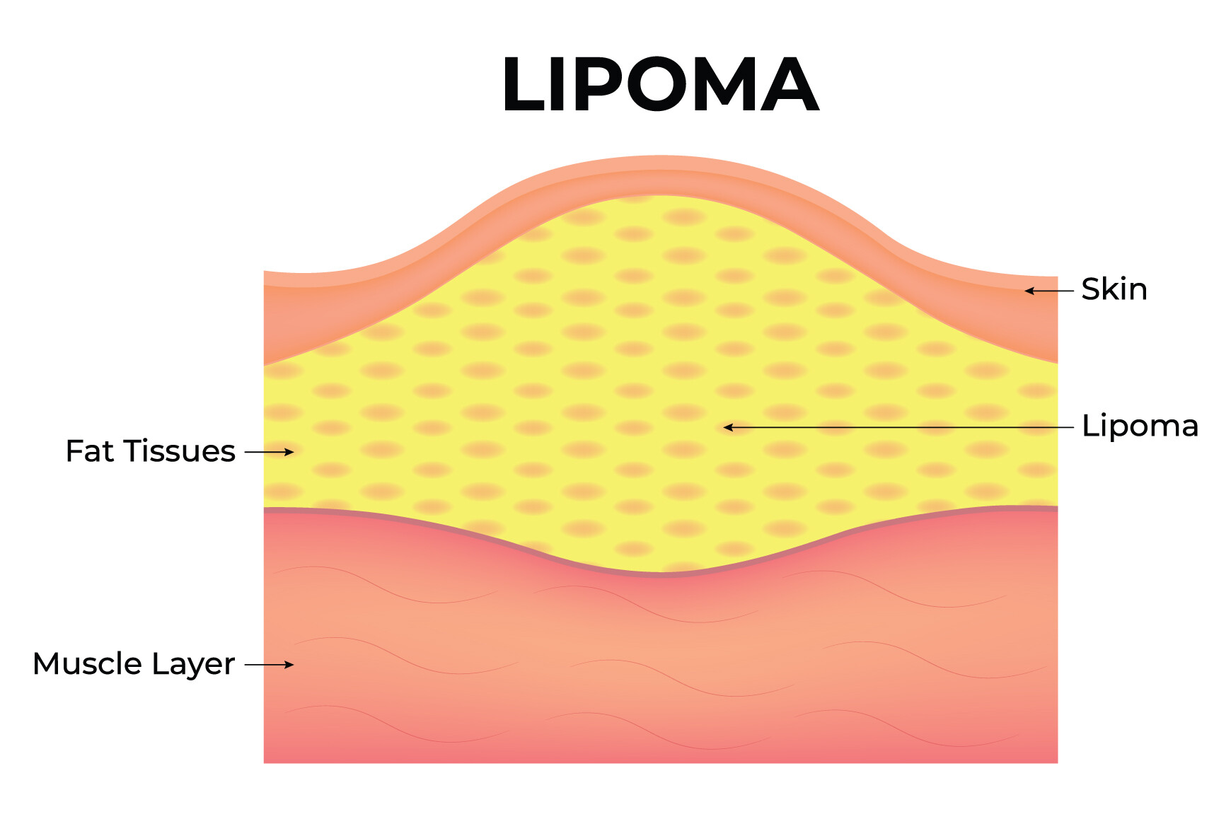 Lipoma Science Design Vector Diagram Graphic by hamjaiu · Creative Fabrica