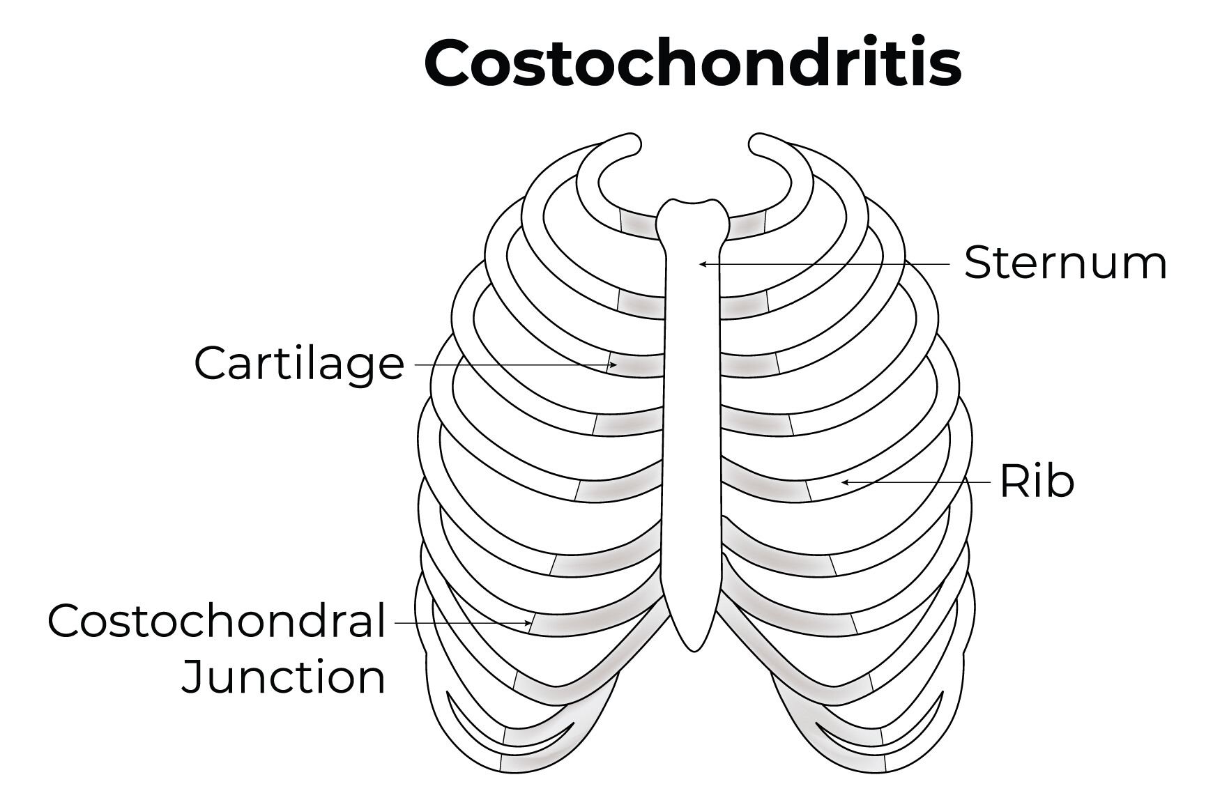 Costochondritis Science Design Vector Graphic by hamjaiu · Creative Fabrica