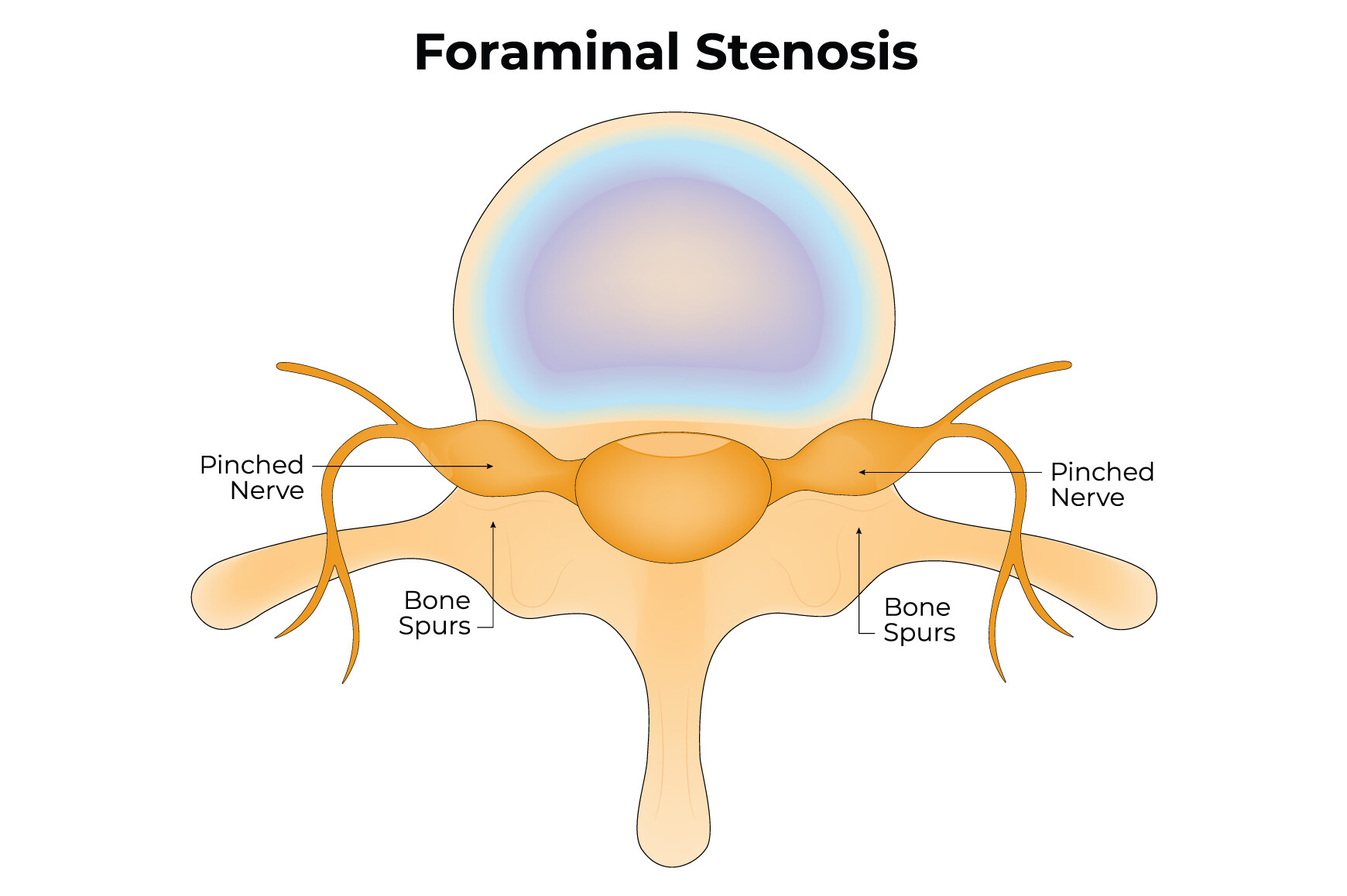 Foraminal Stenosis Science Design Vector Graphic by hamjaiu · Creative ...