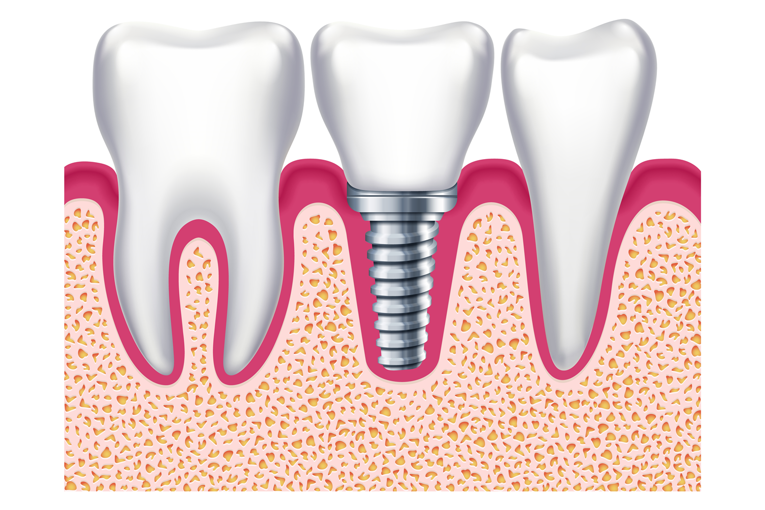 Implant Among Healthy Teeth. Dental Trea Graphic by microvectorone ...