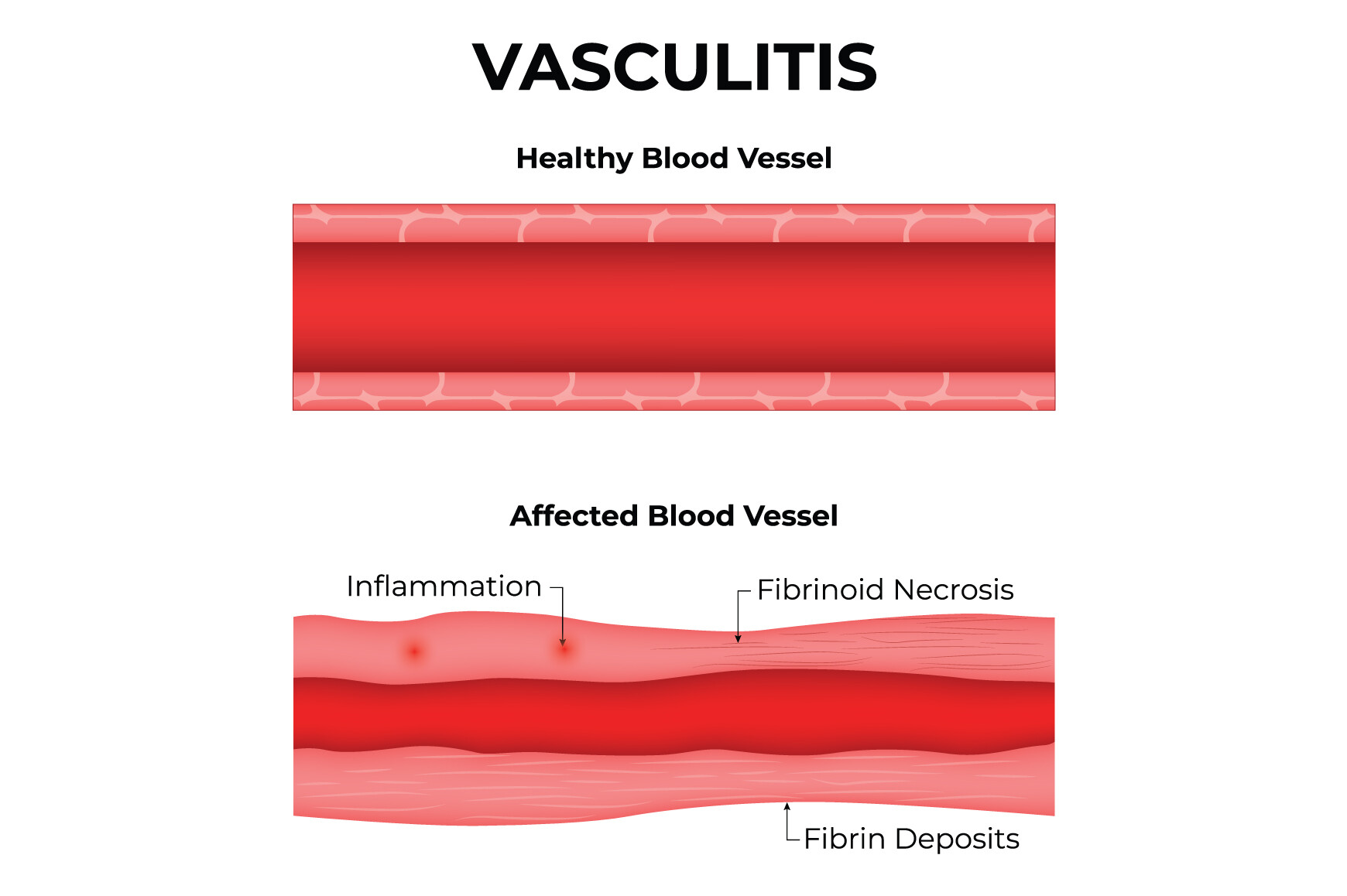 Vasculitis Science Design Vector Graphic by hamjaiu · Creative Fabrica