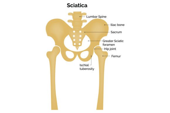 Sciatica Science Design Vector Diagram Graphic by hamjaiu · Creative ...