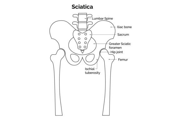 Sciatica Science Design Vector Diagram Graphic by hamjaiu · Creative ...