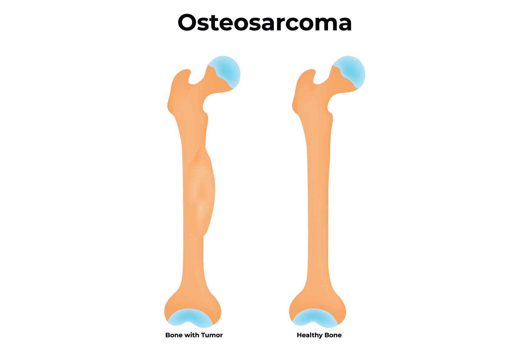 Osteosarcoma Science Design Vector Graphic by hamjaiu · Creative Fabrica