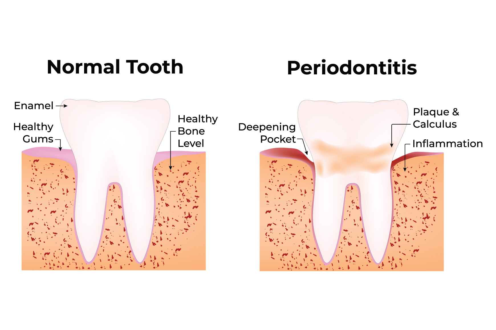 Normal Tooth and Periodontitis Science Graphic by hamjaiu · Creative ...