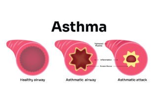 Asthma Science Design Vector Diagram Graphic by hamjaiu · Creative Fabrica