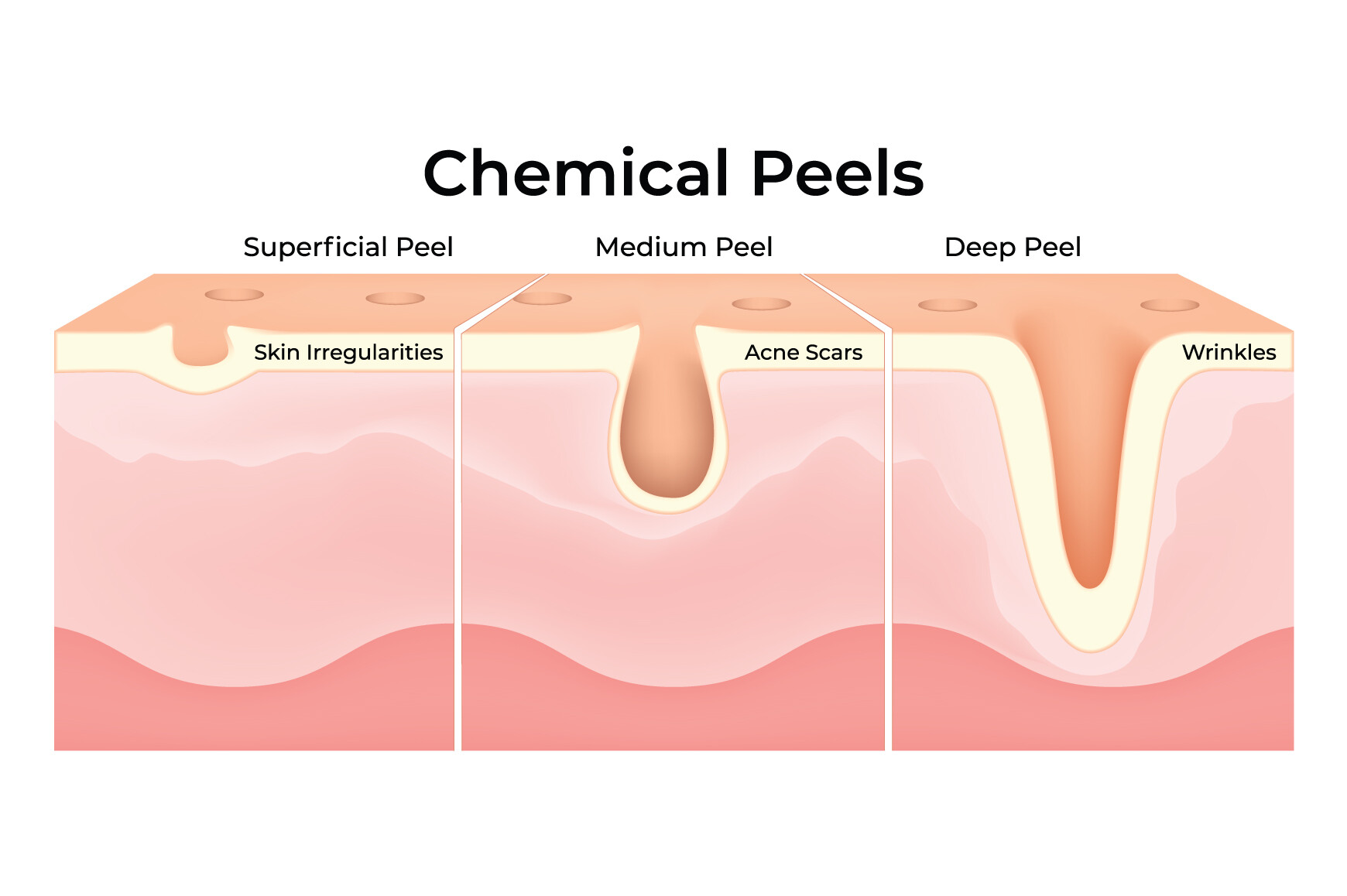 Chemical Peels Science Design Vector Graphic by hamjaiu · Creative Fabrica