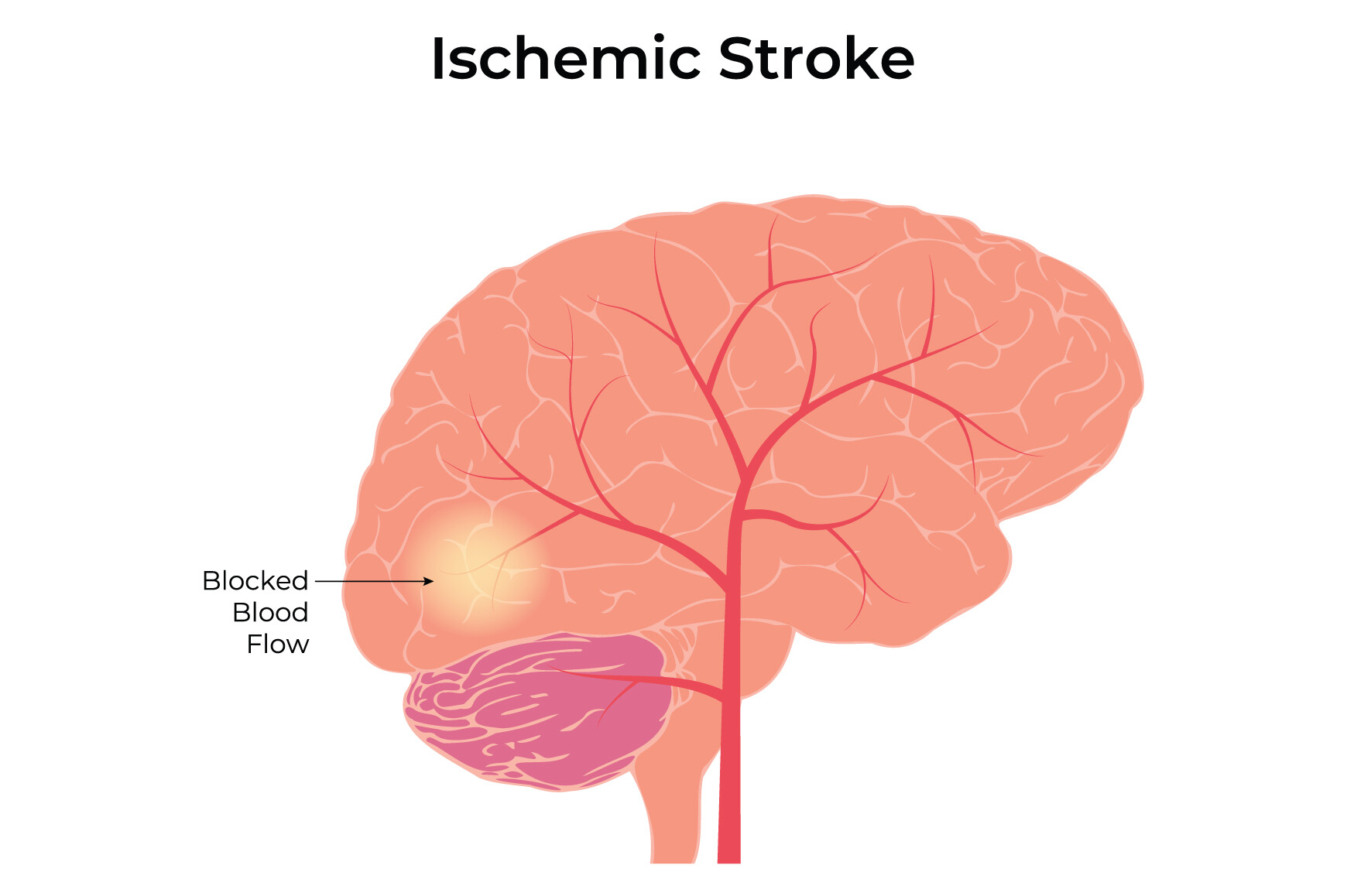 Ischemic Stroke Science Design Vector Graphic by hamjaiu · Creative Fabrica